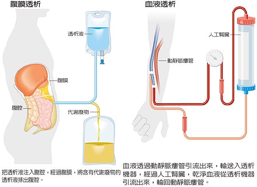 七項重大疾病分析：慢性腎衰竭（尿毒症）